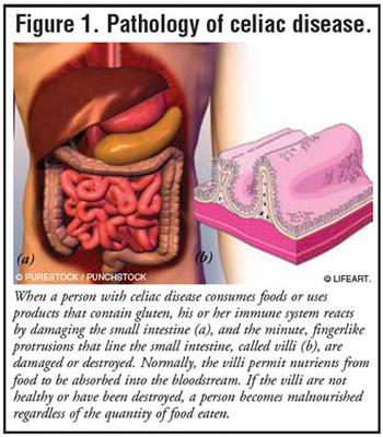 How Celiac Disease Works