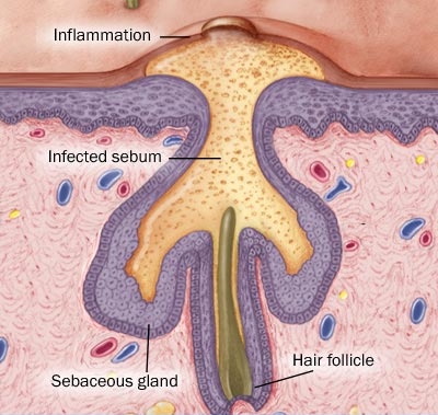 Acne Lesion (© 1998-2013 Mayo Foundation for Medical Education and Research. All rights reserved.)