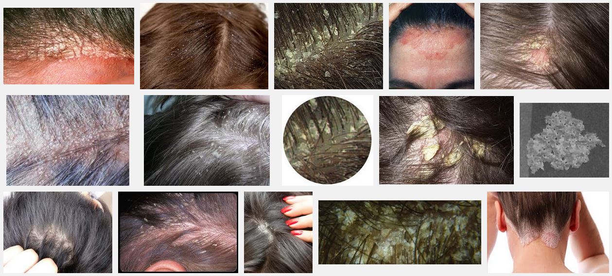 Examples of Dandruff